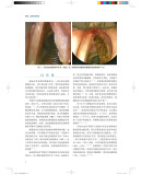 《喉癌：临床病例精要》([巴西] 罗杰里奥·德迪迪蒂斯 等 著) 喉癌的病例分析 喉癌的临床表现有哪些 喉癌病例 简述喉癌的临床表现